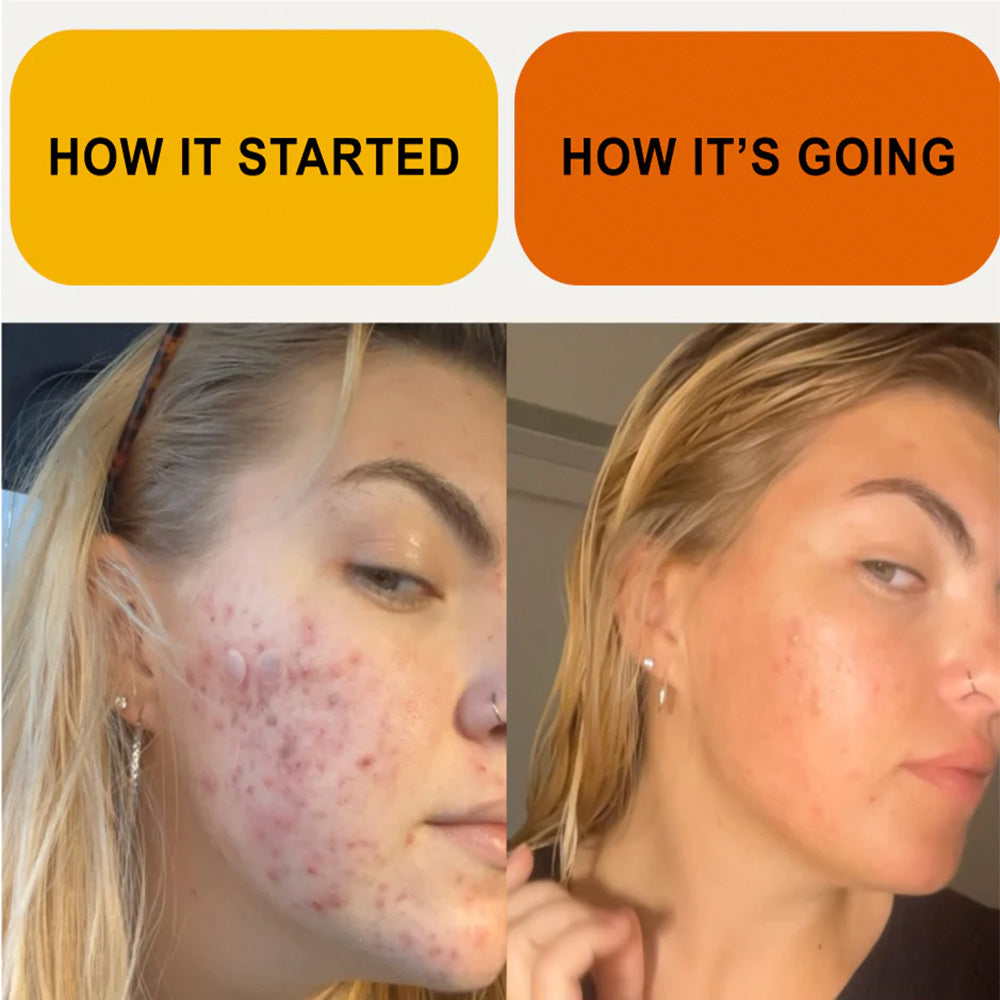 Liver Revive - Fights Fat, Acne & Dull Skin
